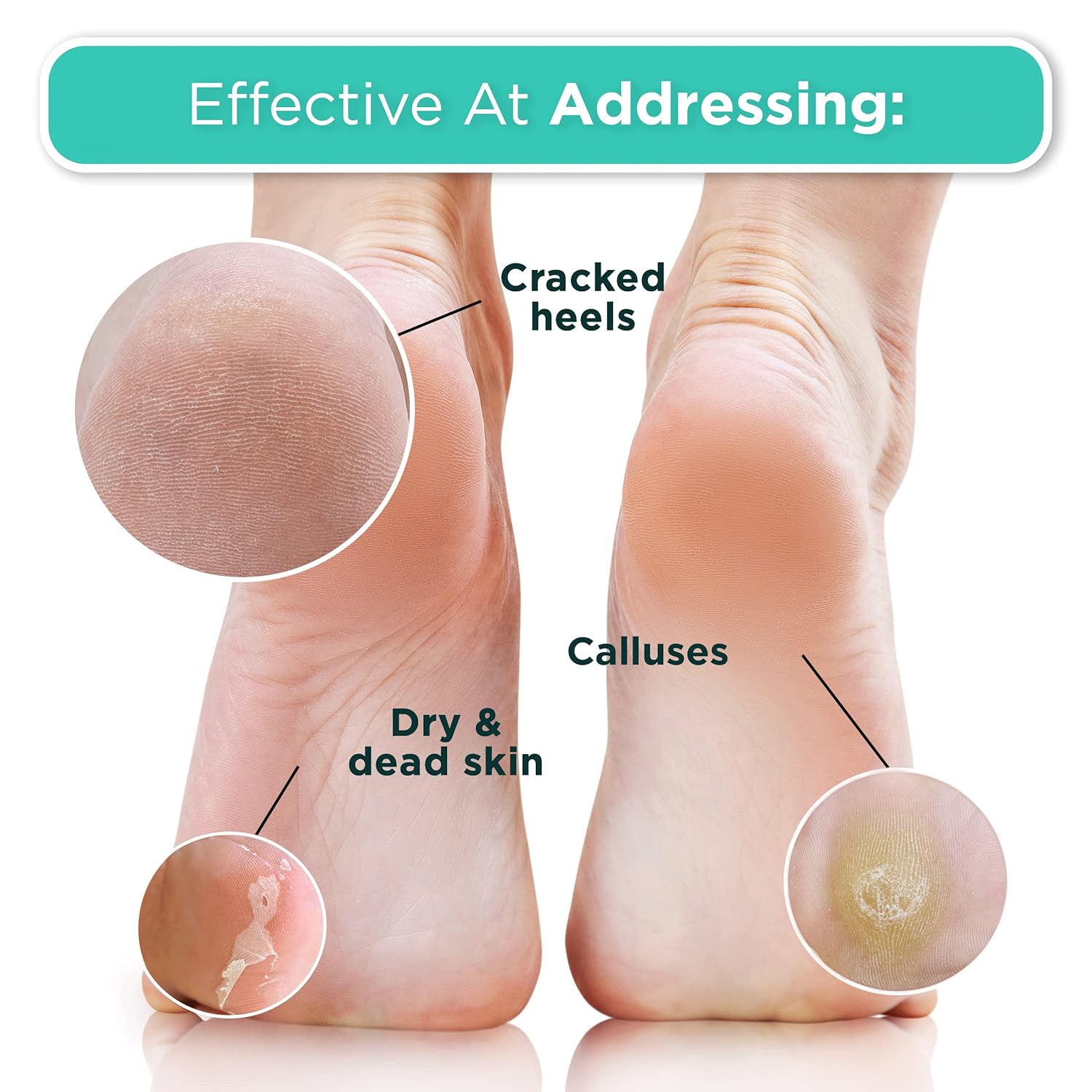 DERMORA Foot Peel Mask 2 Pack for Dry Cracked Feet & Callus